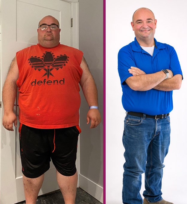 Brad's Gastric Sleeve Before and After