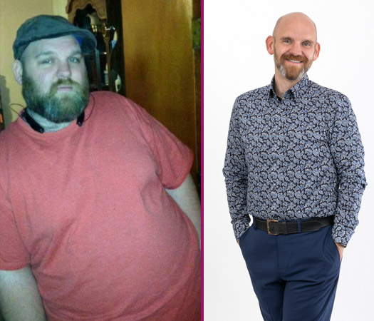 Darwin's Gastric Sleeve Before and After