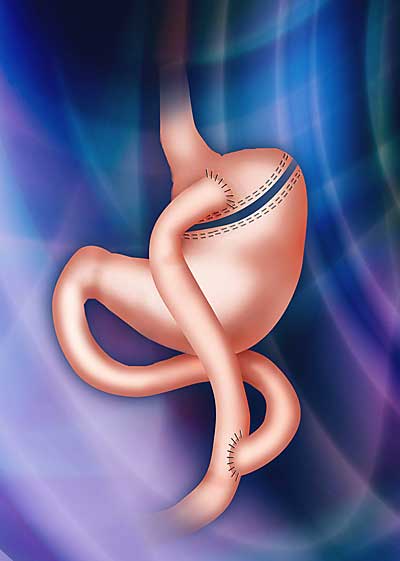 Gastric Bypass Illustration