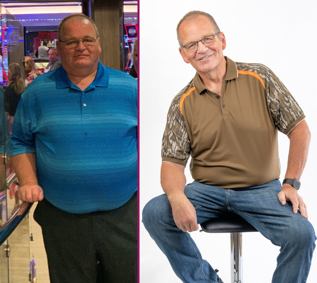 Jim's Bariatric Surgery Before and After