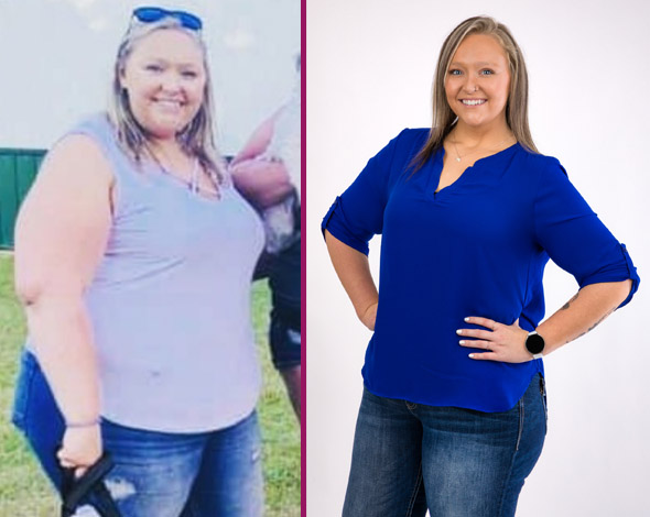 Mackenzie's Bariatric Surgery Before and After