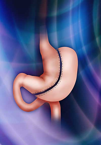 Sleeve Gastrectomy Illustration